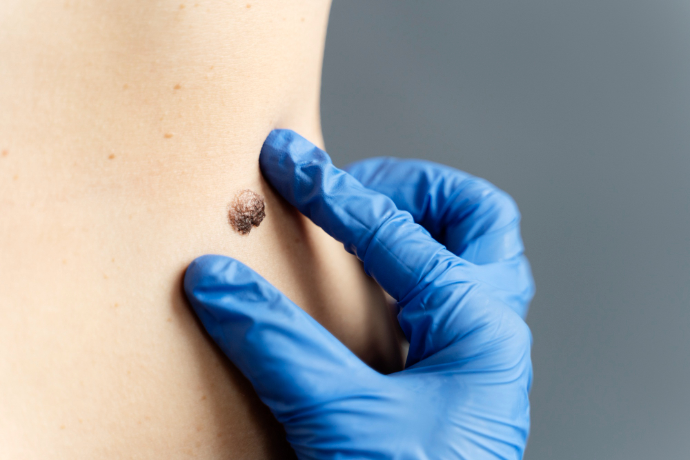Mole and Wart Removal