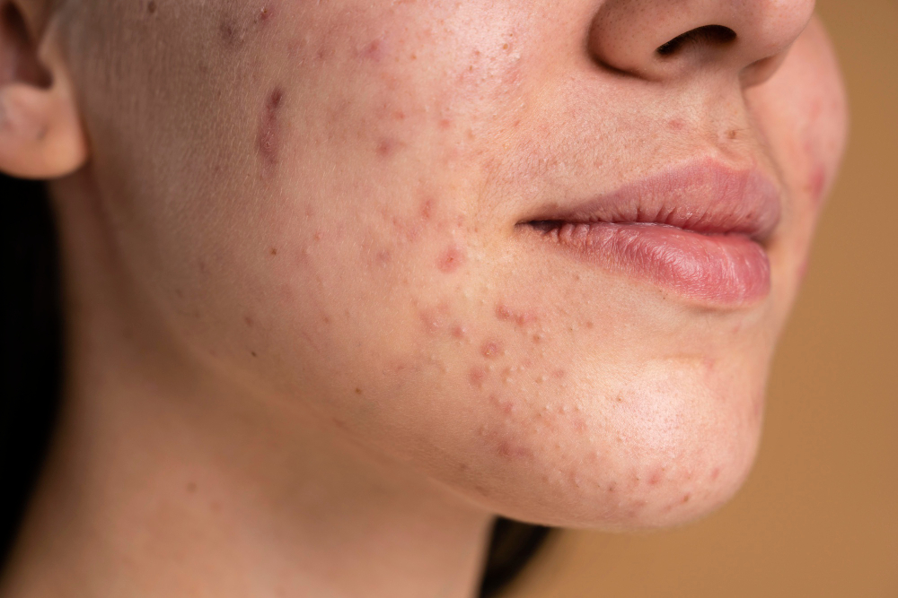acne treatment in vijayawada